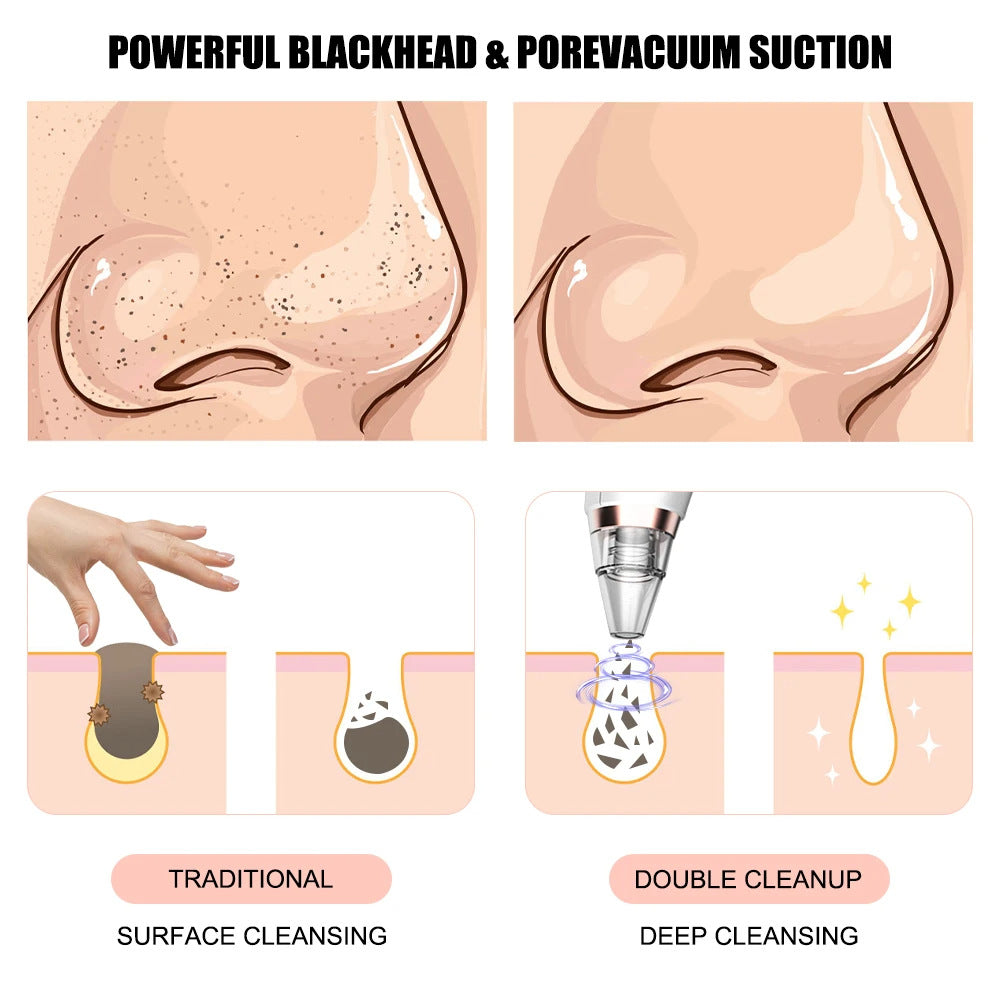 New electric blackhead removal and pore cleaning for blackheads - La Charlottes